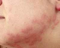 bed bug bites on neck and face photo